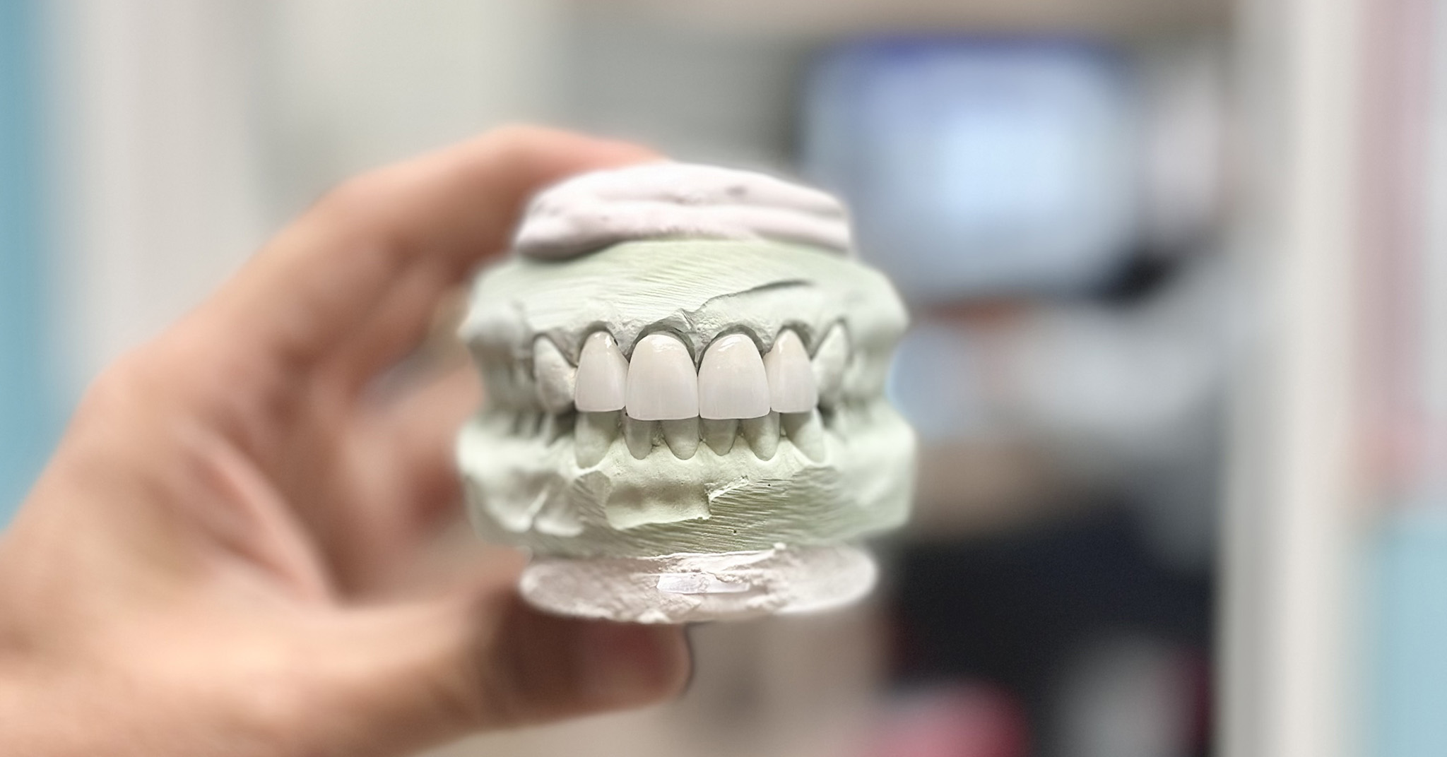 Four dental crown sitting on a model. Oceanic Dental Huntington beach