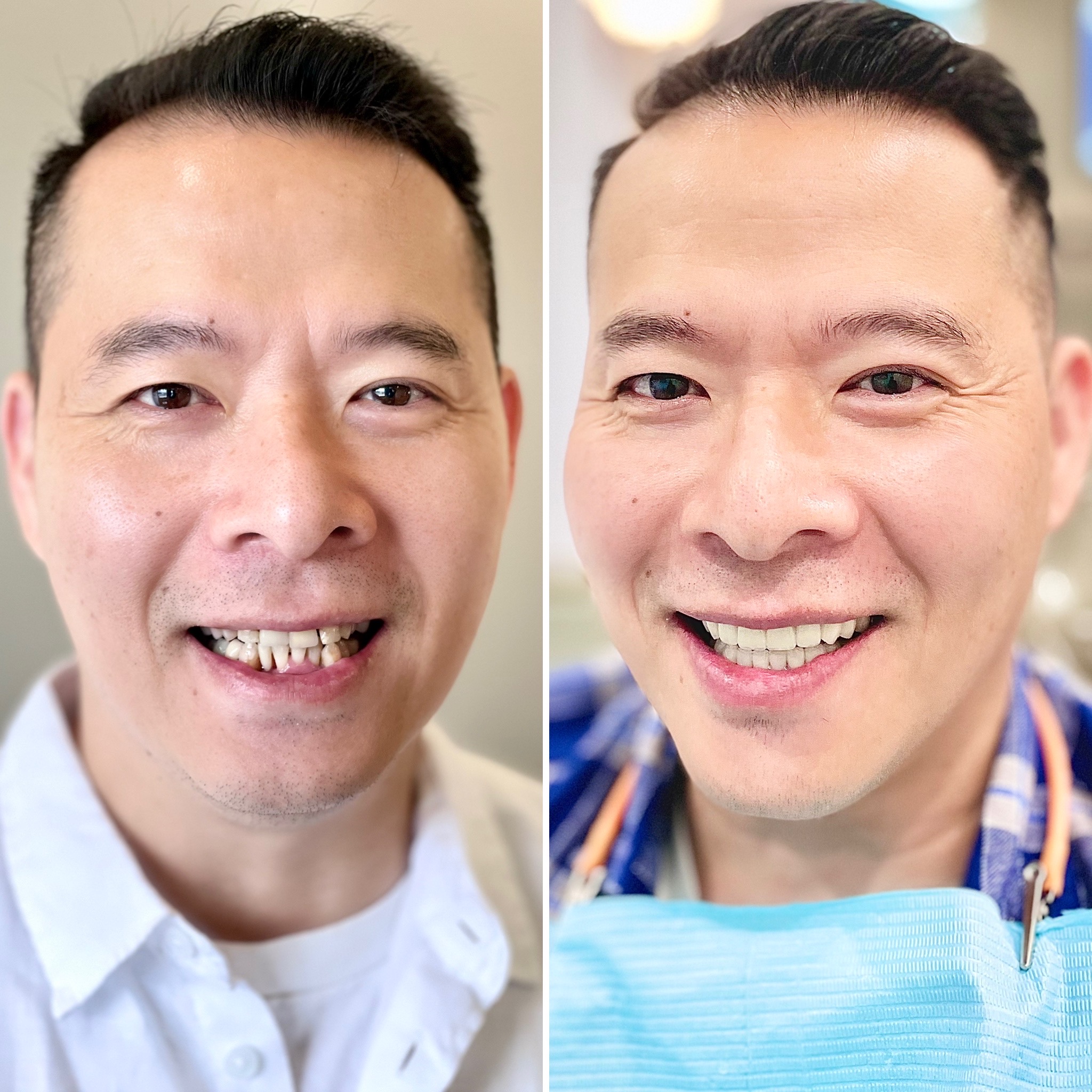 DJ JVL Before and After extensive dental works at Oceanic Dental